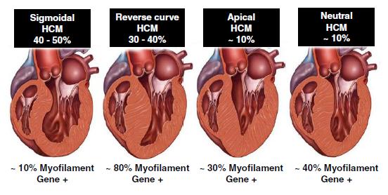 Hypertrofická kardiomyopatie Některé mutace pravděpodobně znamenají vyšší riziko náhlé srdeční smrti