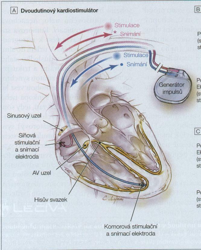 Historie a současnost KS v ČR 1. implantace KS 8.10.