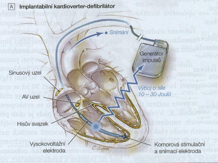 ICD implantabilní kardioverter-defibrilátor 1.
