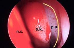 ODBORNÉ SDĚLENÍ 141 endoskopické chirurgie paranazálních dutin (PND) spočívají ve zvýšení přehlednosti operačního pole, snížení rizik iatrogenního poškození a odstranění anatomických překážek s