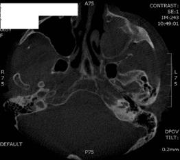 ODBORNÉ SDĚLENÍ 143 FESS u maxilární sinusitidy z důvodu oroantrální komunikace 23 Endoskopicky asistované odstranění cizího tělesa z čelistní dutiny 14 Endoskopicky asistovaná exstirpace cysty z