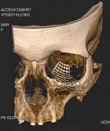 U některých aspergilóz jsme pozorovali i mírnou osteolýzu stěn maxilárního sinu, která je reverzibilní (15). Lopatin et al.