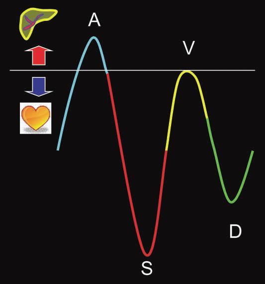 Dopplerovská ultrasonografie JŽ trifazická křivka (centrální žilní charakter) ve skutečnovsti má 4 komponenty: A - retrográdní (při kontrakci síní, část krve se retrográdně vrací zpět) S antegrádní