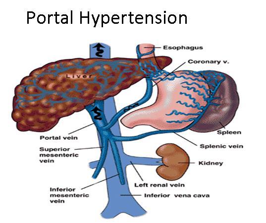 1. typ: PH s poruchou průchodnosti systému VP (presinusoidální prehepatální) Portální hypertenze zevní komprese VP, trombosa VP, arterioport. fistula, uzávěr přítoku (VL, VMS) 2.