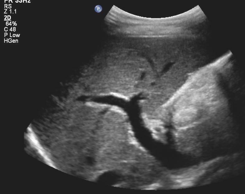 Dopplerovská ultrasonografie VP nutno vyšetřovat na lačno.