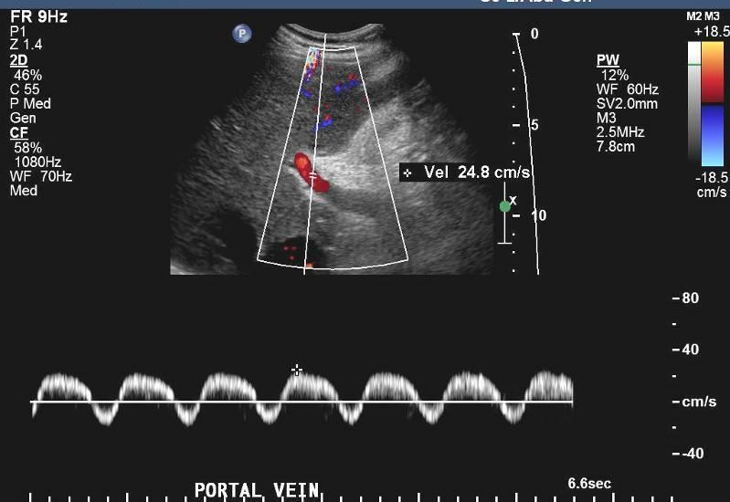 Dopplerovská ultrasonografie normální nález hepatopetální tok ve VP norm.