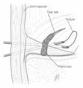 channels inside-out trepanace jehlou