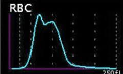 Abnormality v histogramech - příklad RBC