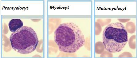 Nové parametry měřené na XN 5000 TM IG (Immature granulocytes) = nezralé granulocyty Zahrnuje promyelocyty, myelocyty, metamyelocyty tyče NE Normálně může být pouze u