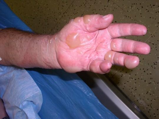 III. stupeň zasažena je hlubší vrstva dermis, ztráta kůže v celém rozsahu