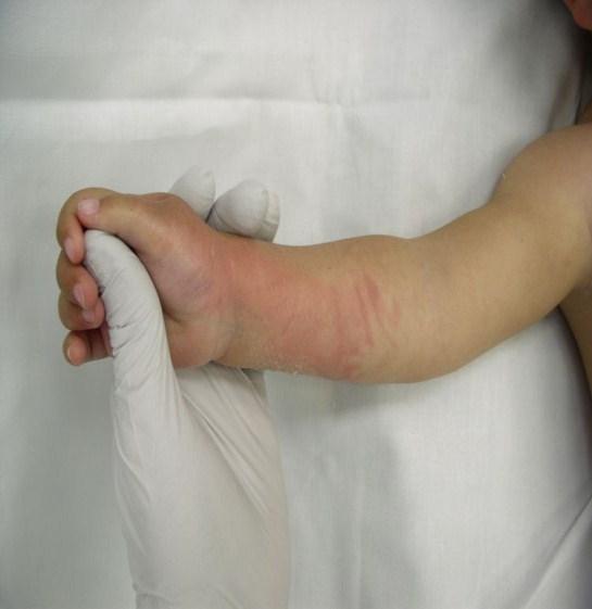 20, nekrektomie s krytím xenotransplantáty, umělou kůží Integra (kryt z