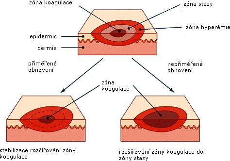 Popáleniny způsobené chladem I. stupeň charakterizován zčervenáním. II. stupeň vzniká parestezie a hyperémie, tvoří se puchýře. III. stupeň vytváří se edém, vznikají nekrózy. [6,7,21] 3.