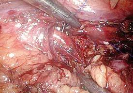 Jehla zapíchnutá v pravé ledvině Fig. 4. Needle digged in the right kidney Obr. 5.