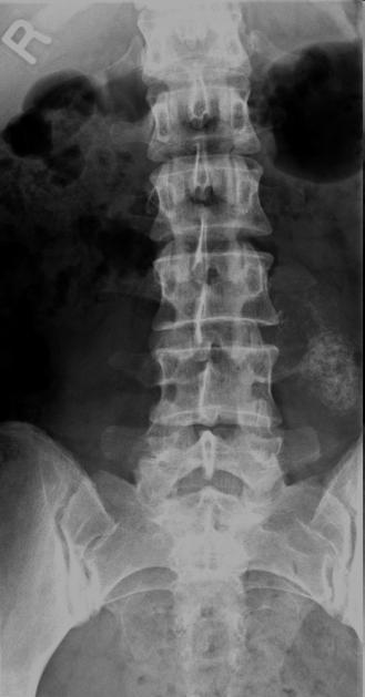 Podozrenie na závažnú organickú príčinu bolestí chrbtice Vek > 50 rokov Veľmi intenzívne bolesti chrbtice Trvanie bolestí > 1mesiac, narastajúca intenzita Kľudová a