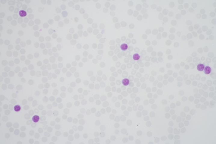 Alemtuzumab AloTx 100 Rozsah infiltrácie KD 90