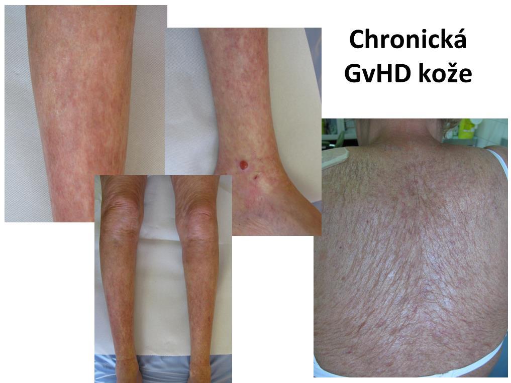 Ťažká forma Výkonnostný stav: 2 cgvhd Pečeň (elevácia prevažne cholestatických enzýmov) Koža (suchá, sklerotické a lichenu-podobné zmeny, depigmentácia a hyperpigmentácia, jemné