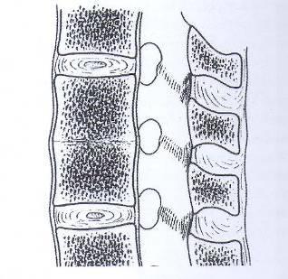 hemivertebra