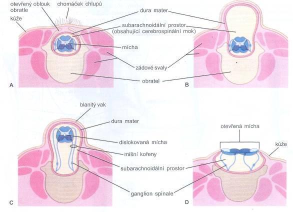 meningomyelocoele