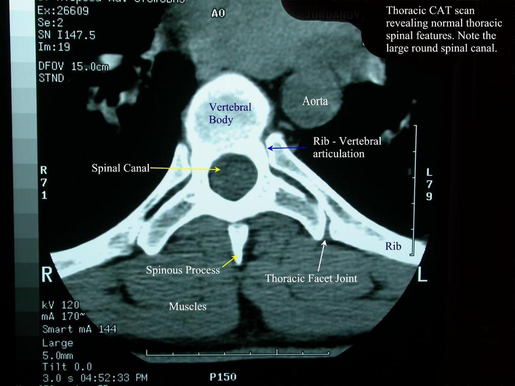 CT hrudního obratle