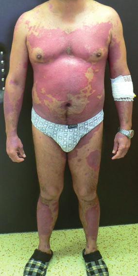 ODBORNÝ ČLÁNEK 9 Laboratorní výsledky má pacient dlouhodobě v normě, nežádoucí účinky při celkové terapii Humira inj. nejsou u něj pozorovány.