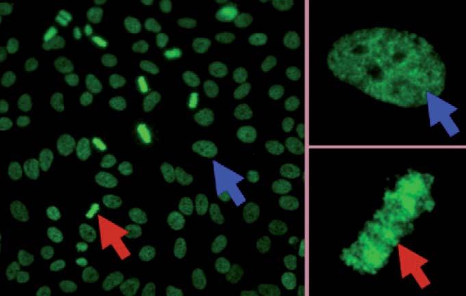 Synonyma: LEDGF/p75, TCp75, LEDGF Antinukleární protilátky byly vždy považovány za klíčový serologický marker systémových revmatických chorob (SARD).