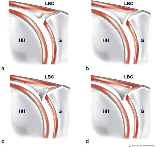 SLAP léze Superior Labrum Anterior to Posterior= poškození horní části glenoidálního labra před-a za úponem šlachy dlouhé hlavy bicepsu Častá u házejících sportovců, vzniká obvykle tahem šlachy