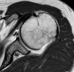 SLAP léze trhlina zasahuje do laterálnějšíčásti labra Sublabrální foramen