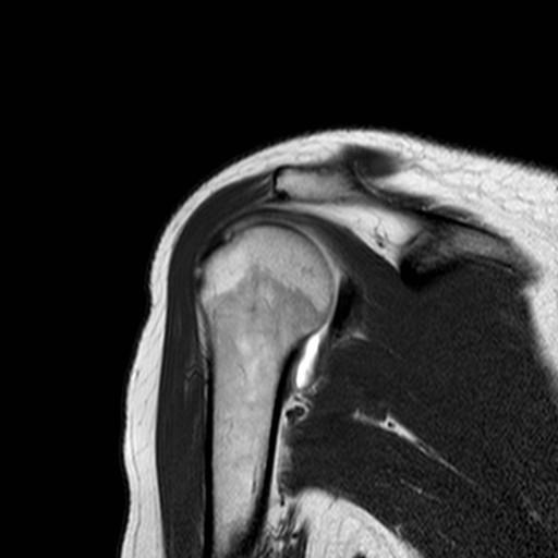 Anatomie tendo m. infraspinati labrum glenoidale m.