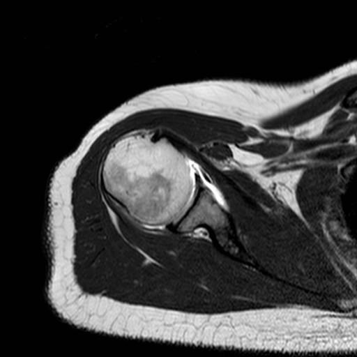 Anatomie tendo capitis long. m.