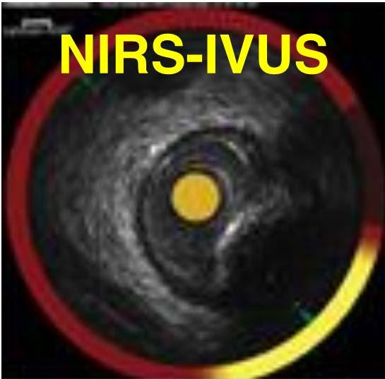 NIRS - princip Near infra-red spectroscopy Vysílač emituje světlo o vlnové délce 780-2500 nm Světlo je absorbováno tkáněmi v závislosti na jejich