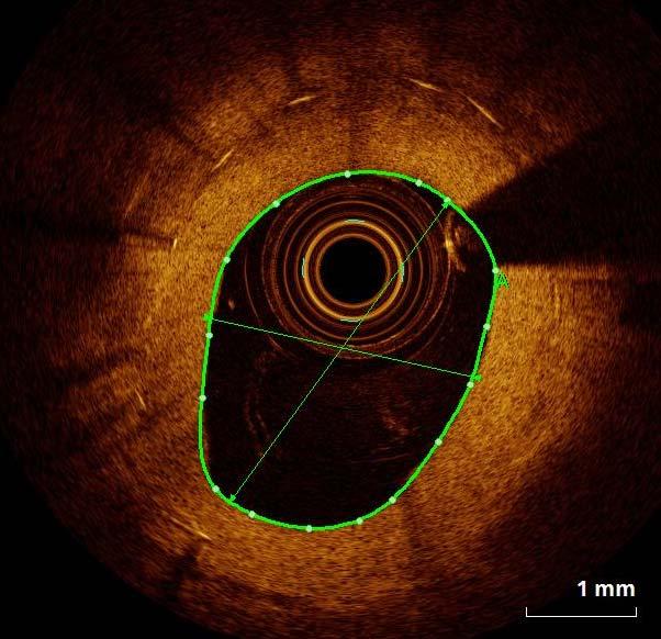 In-stent