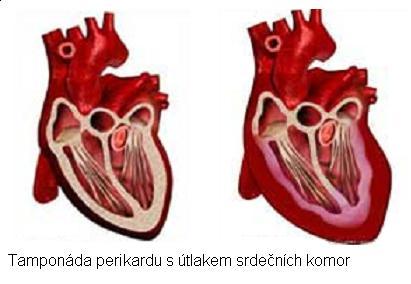 Nejčastěji se s obstrukčním šokem setkáváme při pneumotoraxu, agresivní umělé plicní ventilace, embolizaci do povodí a. pulmonalis, astmatu.