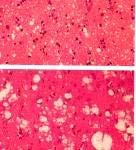 LABORATORNÍ DIAGNOSTIKA: Neurohistopatologie vzorky z pitevního materiálu spongiformní změny (opticky prázdné prostory vzhled mycí houby), úbytek neuronů a zmnožení astrocytů (astrocytózu) amyloidní