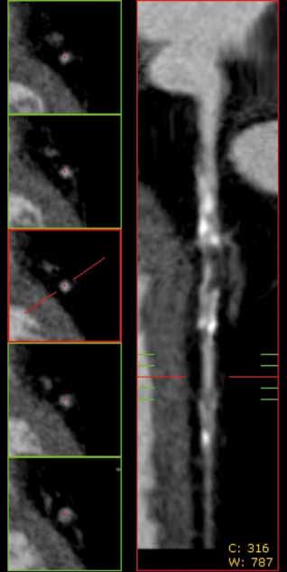 Evaluation of the coronary arteries.