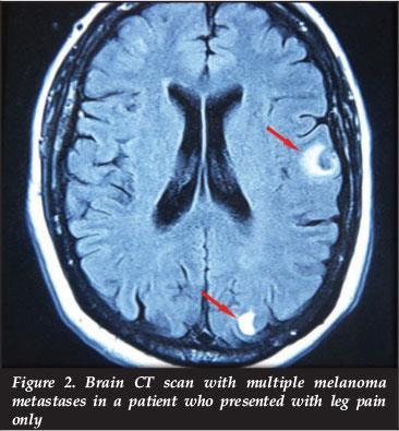 Příklady výpočetních tomogramů Metastatické léze v mozku http://www.mc.vanderbilt.edu/vumcdept/emerg ency/mayxr3.