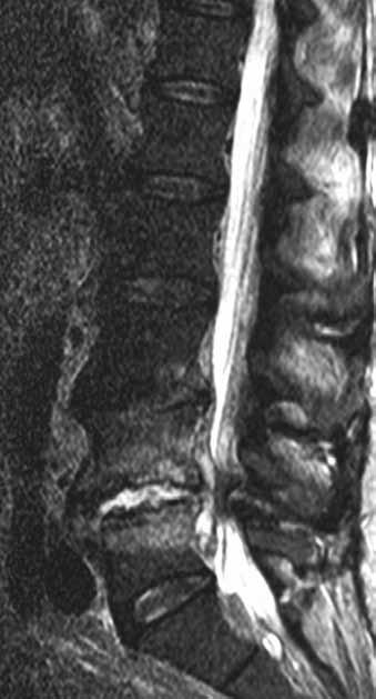 A B C Obr. 1. MR vyšetření bederní páteře u pacienta se spondylodiscitidou v etáži L 4/5 (pacient č. 2). Obr. 1A) STIR sekvence, sagitální rovina.