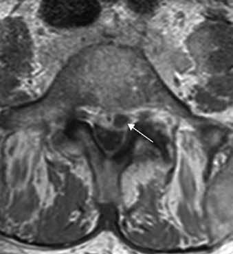 Abscesová kolekce za tělem L5 paramediálně vlevo šíře až 10 mm (šipka). Fig. 1. MRI examination of the lumbar spine in a patient with spondylodiscitis at the L4/5 level (patient No. 2). Obr.