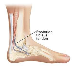 Tendinitis m.tib.