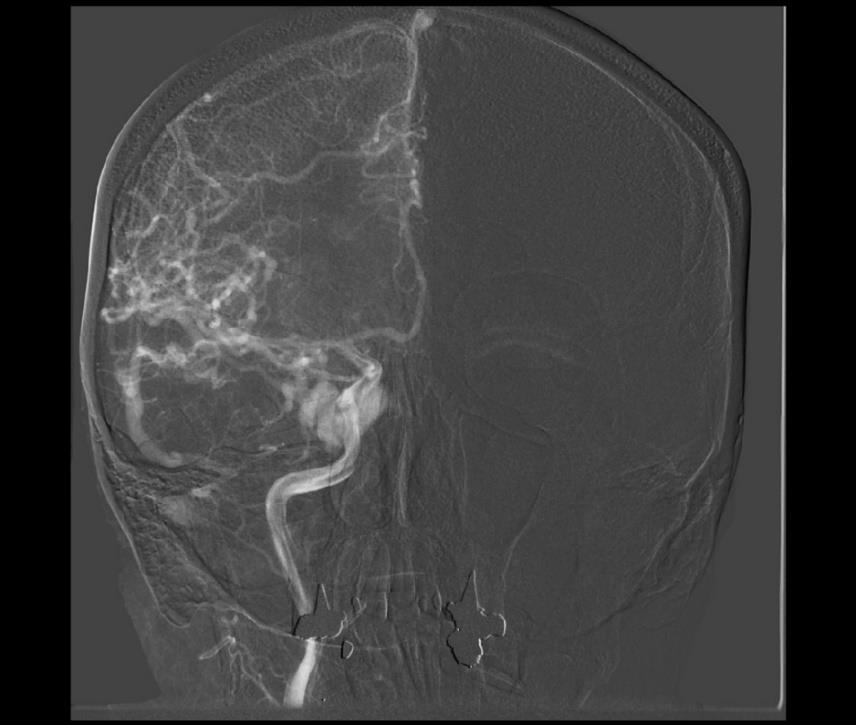 Obrázek 8 DSA arteriovenozního zkratu v kavernozní oblasti Zdroj: Winmedicalc Plzeň Závěr: Nález charakteru AVM s vícečetnými přítoky především z ACE, menší podíl z ACI vpravo, rovněž žilní drenáž