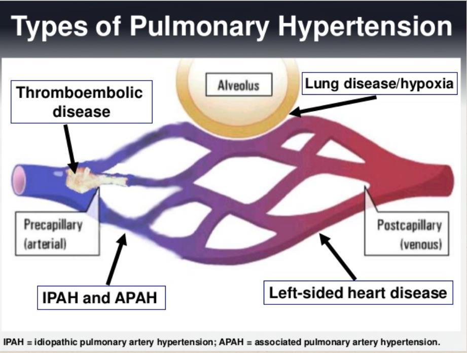 Oběhová insuficience - poruchy cévního systému primární 1 % idiopatická PLICNÍ HYPERTENZE sekundární 99% akutní plicní embolie pneumonie