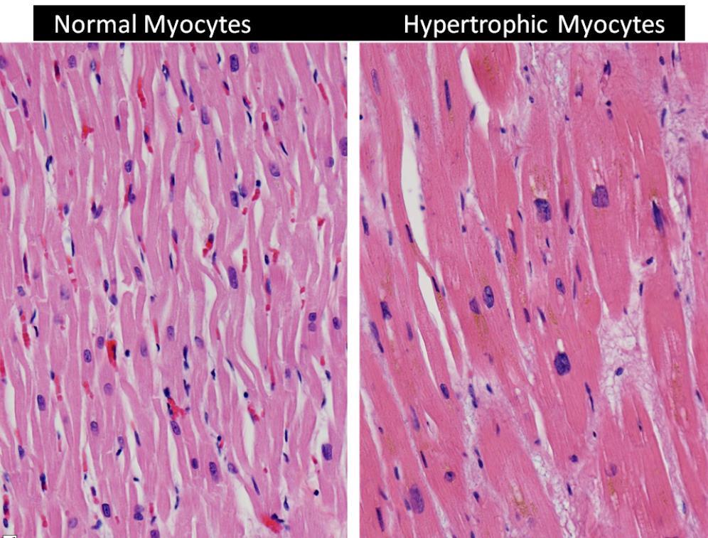 Projevy oběhového selhávání na srdci Hypertrofické kardiomyocyty zmnožení