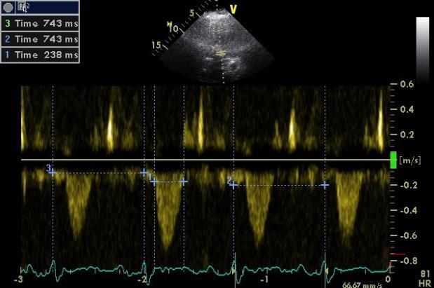 = 60 (30 + 19) = 11s Applications in ischaemic heart