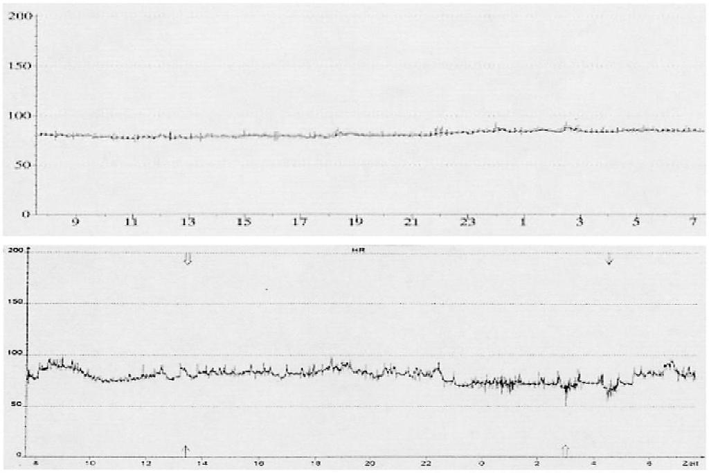 Low HR variability in sepsis (Schmidt H et al: Autonomic dysfunction in the