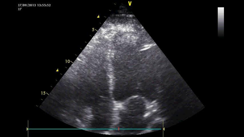 , Mycoplasma Risk of septic cardiomyopathy (incidence of 15-60%;