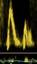 pulmonary vein PW - Degree of