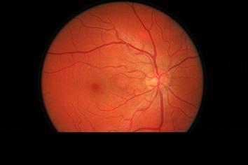 UTB ve Zlíně, Fakulta aplikované informatiky 24 1.3.1.2 Oční sítnice Identifikace osoby podle oční sítnice je založena na zkoumání tvaru vnitřní části oka kolem tzv. slepé skvrny.