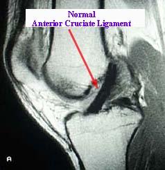 emedx.com/emedx/diagnosis_information/knee_disorders/acl_mri_pictures.htm) Artroskopie je miniinvazivní diagnostická a operační metoda.