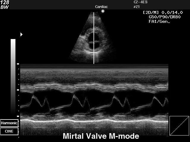 M mód Pohyby struktur v čase měření vzdáleností 2D obrazem (B mode)je proložena linie, která se scanuje v čase ( vysoké