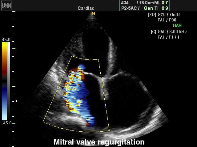 Colour flow Doppler imaging (CFI) Rychlostem a směru pohybu