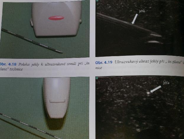 Základní pohyby se sondou IN PLANE jehla paralerně se sondou Jehla zřetelněší tím víc, čím je kolměji k UZ